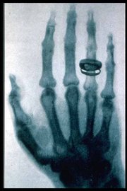 An X-ray picture (radiograph) taken by Röntgen
