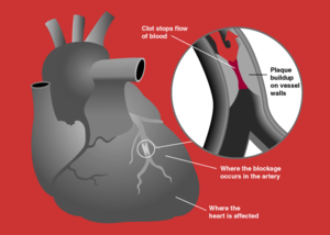 A myocardial infarction occurs when an  slowly builds up in the inner lining of a  and then suddenly ruptures, totally occluding the artery and preventing blood flow downstream.