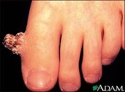 A very large wart on the foot.