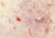 Acid-fast bacilli (AFB) (shown in red) are tubercle  .