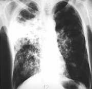 Tuberculous lungs show up on an  image