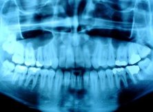X-rays can reveal the details of bones and teeth
