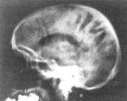Pneumo-encephalogram of person with psychosis, 1935